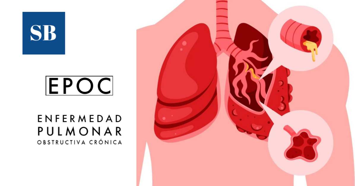 EPOC qué es esta enfermedad Factores síntomas diagnóstico y